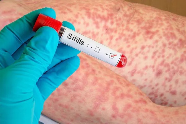 BEAT 991 Crecen los casos de sífilis en Entre Ríos